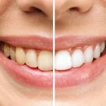 Affordable veneers