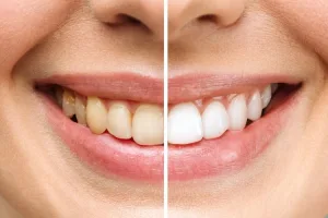Affordable veneers