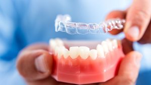 Clear Aligners