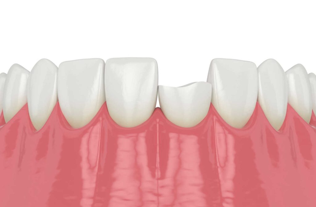 Chipped Tooth