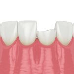 Chipped Tooth