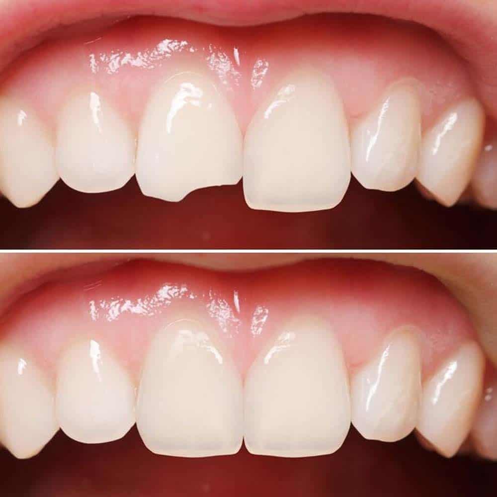 Chipped Tooth Repair