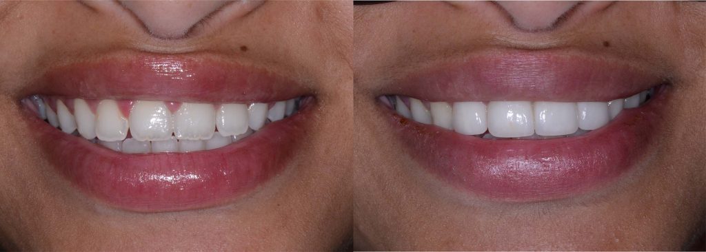 A front tooth before (right) and after (left) a porcelain veneer is applied. The veneer completely covers a discoloured, chipped tooth with a natural-looking white surface