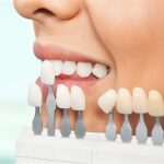dental veneers