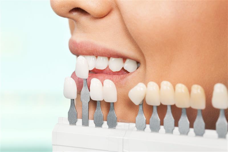 dental veneers