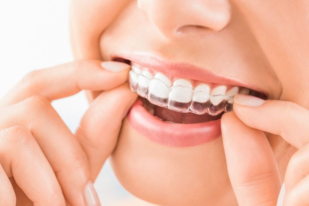 Close-up of clear aligners on teeth