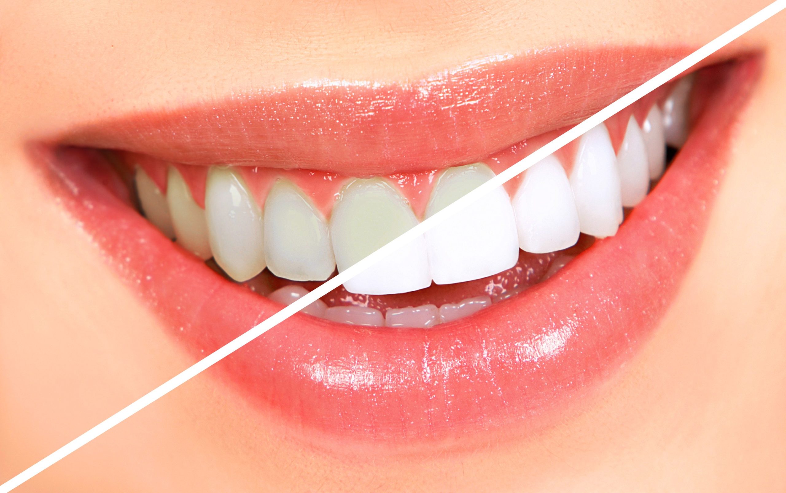 Teeth Whitening: Myths, Facts & Expert Advice