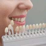 tooth coloured fillings brisbane
