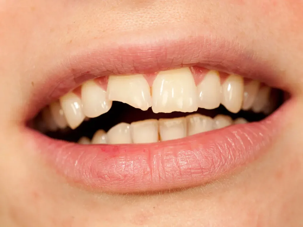 Tooth Fractures