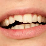 Tooth Fractures