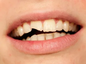 Tooth Fractures