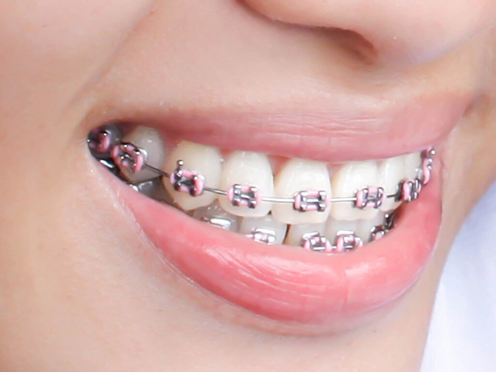 Traditional braces close-up with colored elastics
