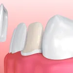 Dental Veneers