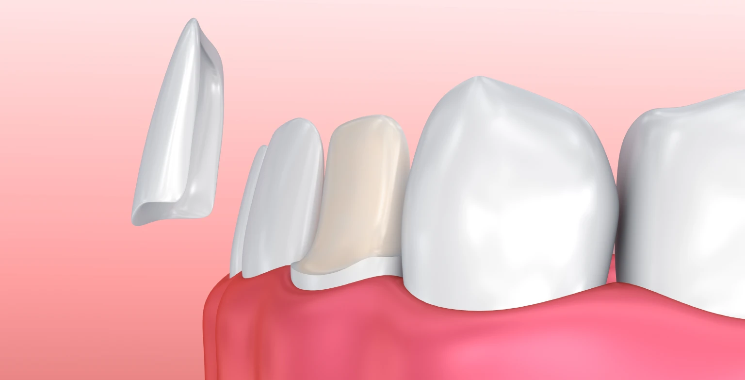 Dental Veneers
