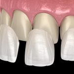 dental veneers