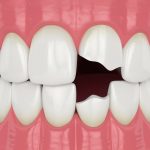 Fix Damaged Teeth