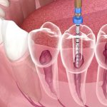 Root Canal in Brisbane