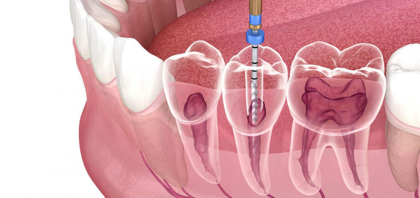 Root Canal in Brisbane