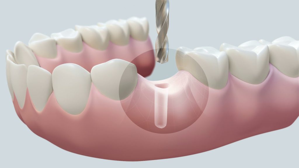 One Day Dental Implants