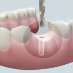 One Day Dental Implants