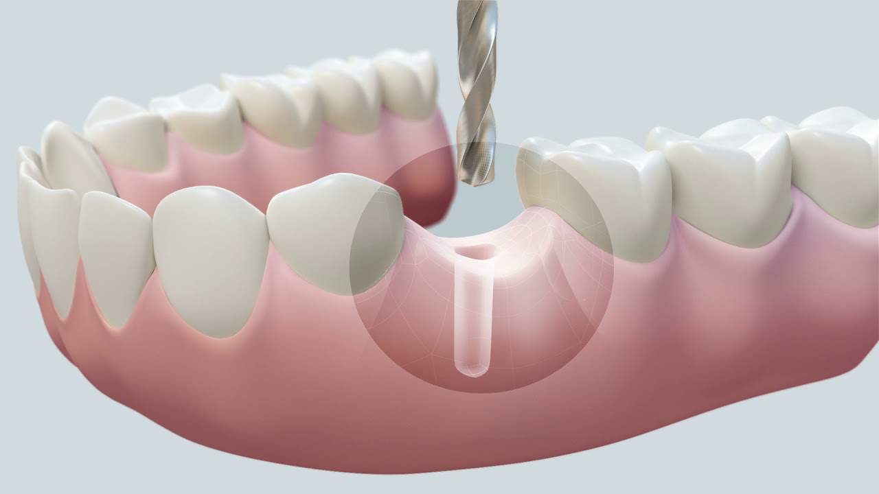 One Day Dental Implants