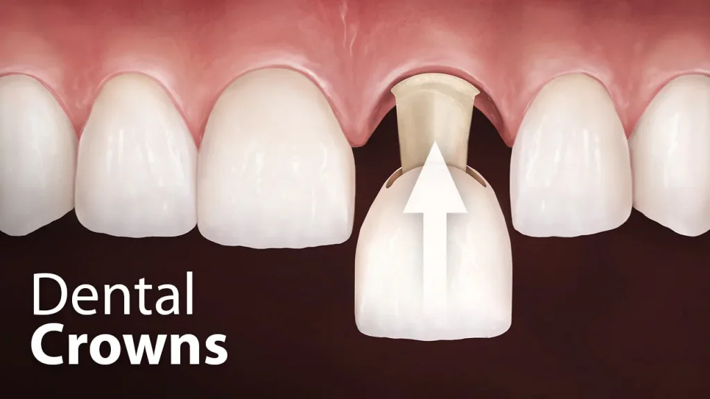 dental crowns