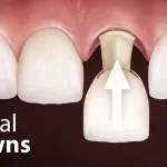 dental crowns