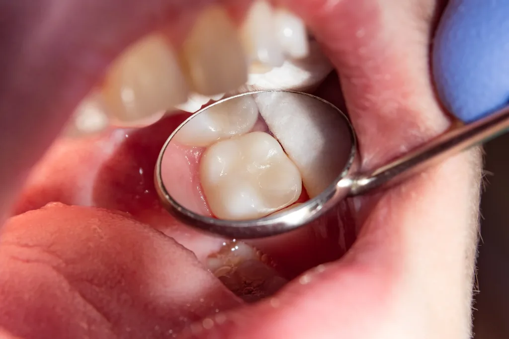 Amalgam Removal brisbane
