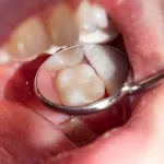 Amalgam Removal brisbane