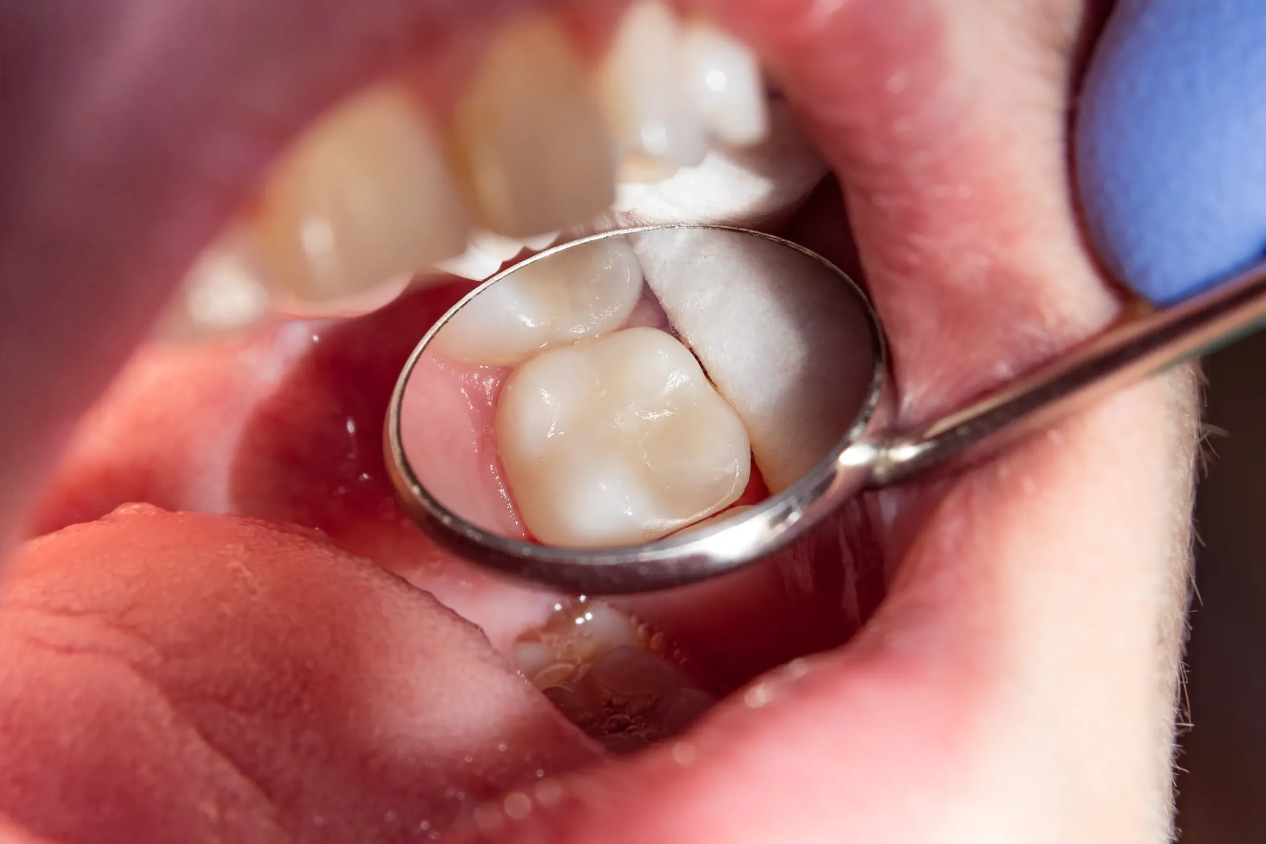 Amalgam Removal brisbane