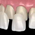 Veneers red hill