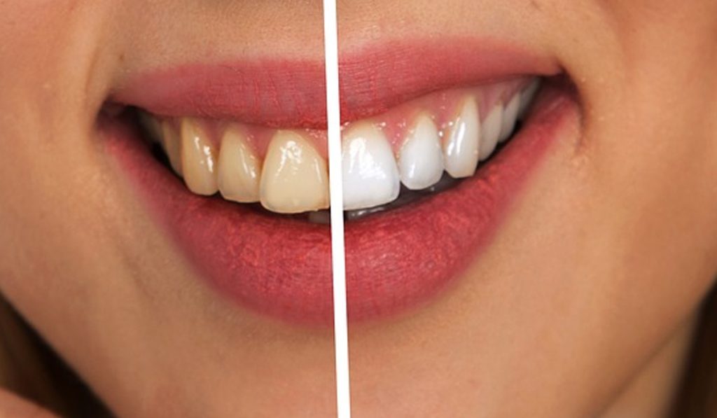 Treat Stained Teeth