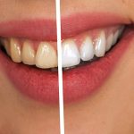 Treat Stained Teeth