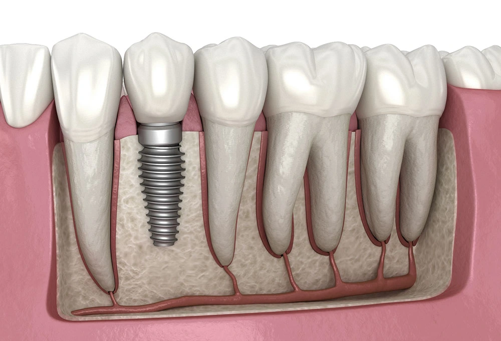Diagram of a titanium dental implant anchored in the jaw, supporting a new tooth