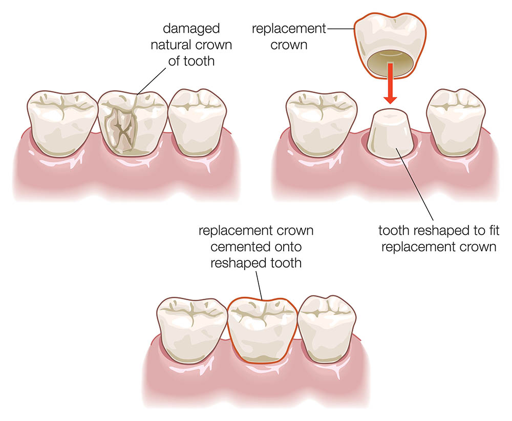 A dental crown (cap) being fitted over a prepared tooth. 