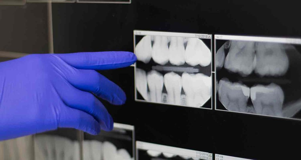 Digital Dental X-Rays brisbane