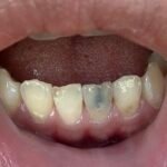 Darker Teeth