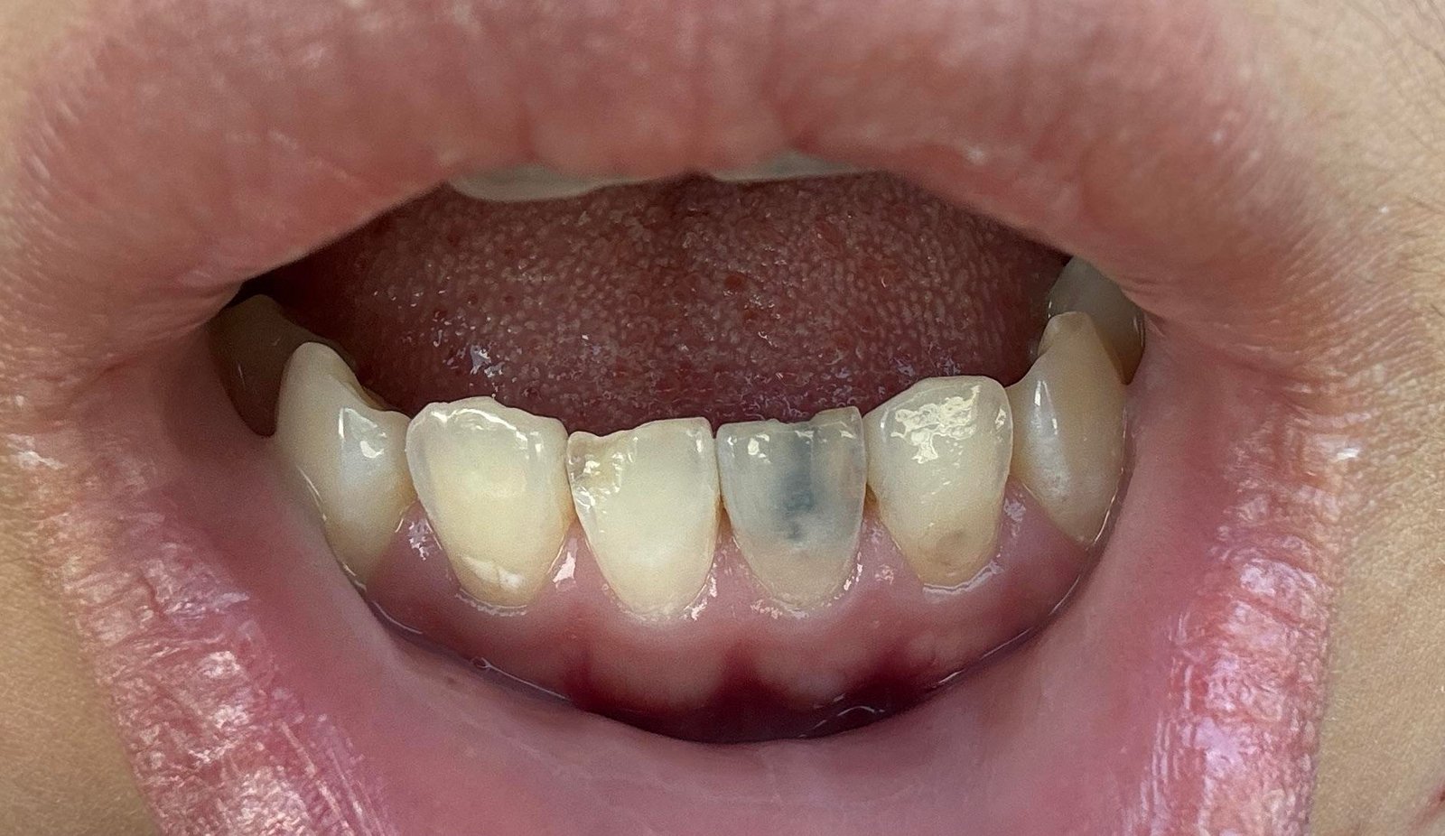 Darker Teeth