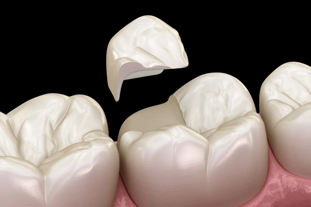 Dental Sealants