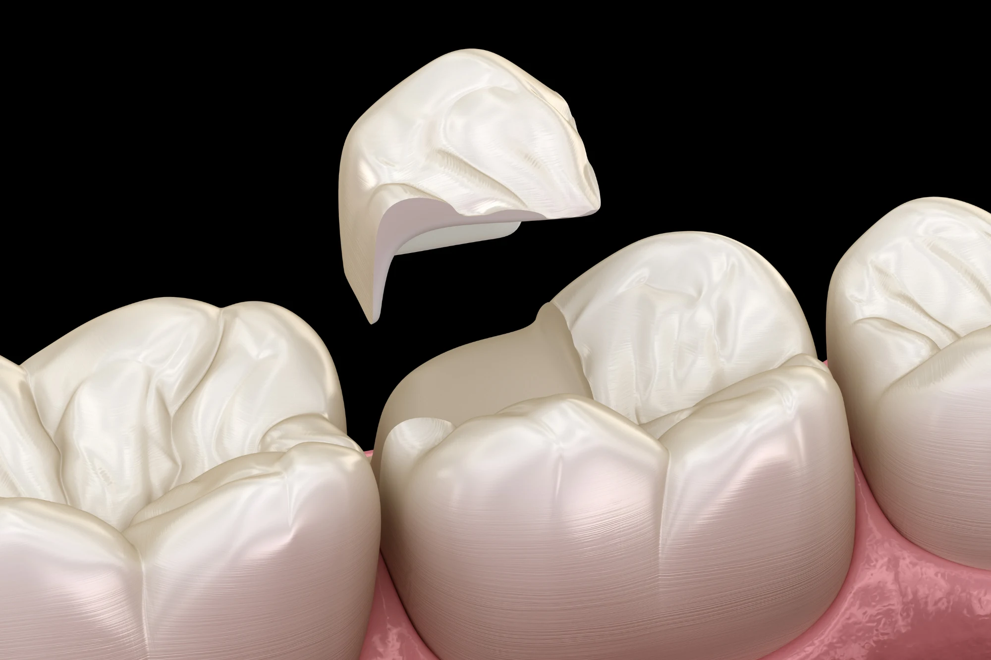 Dental Sealants