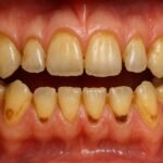 Enamel Erosion