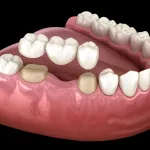 Dental Bridge