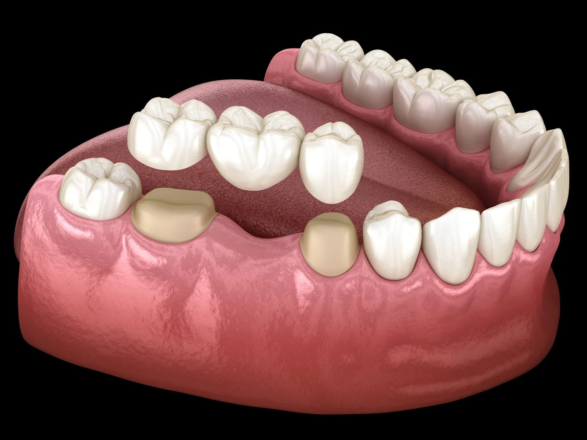 Dental Bridge