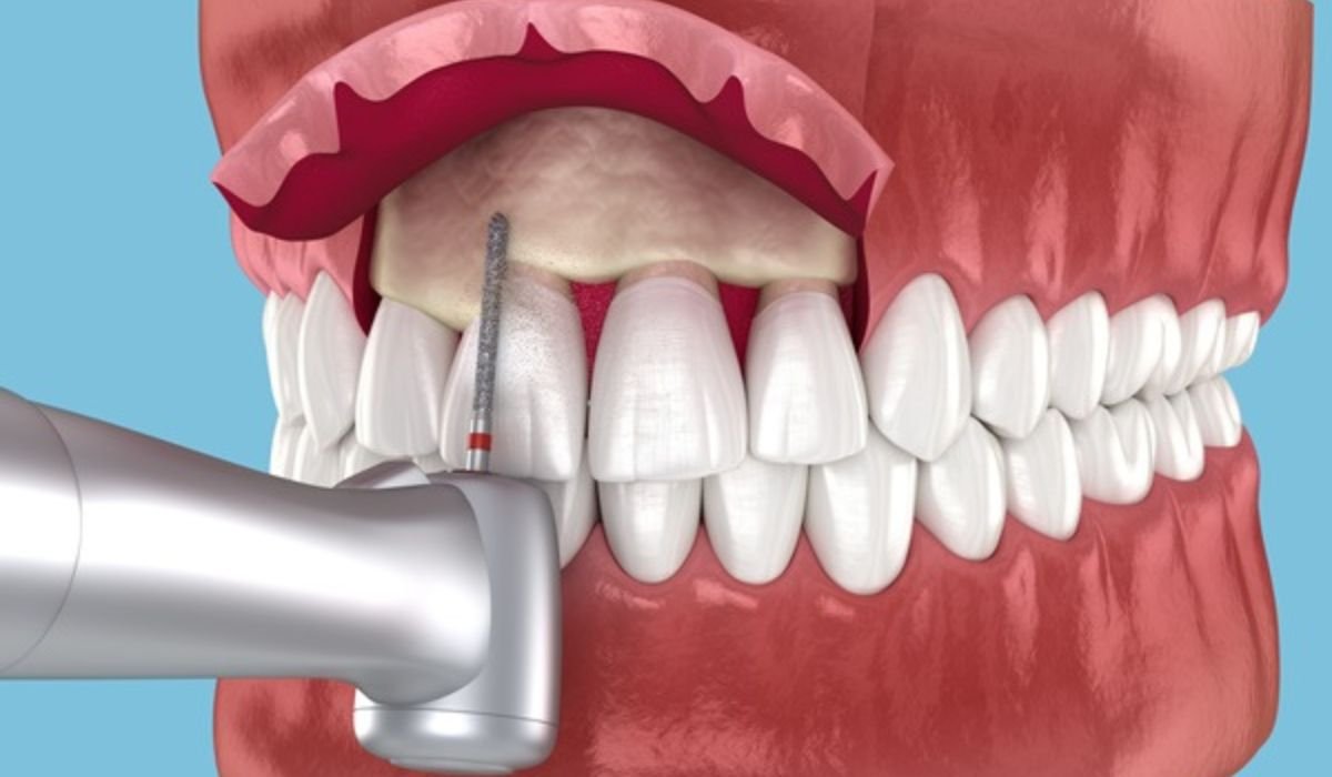 dental crown lengthening