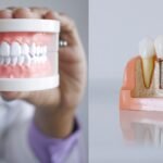 Dentures vs Dental Implants