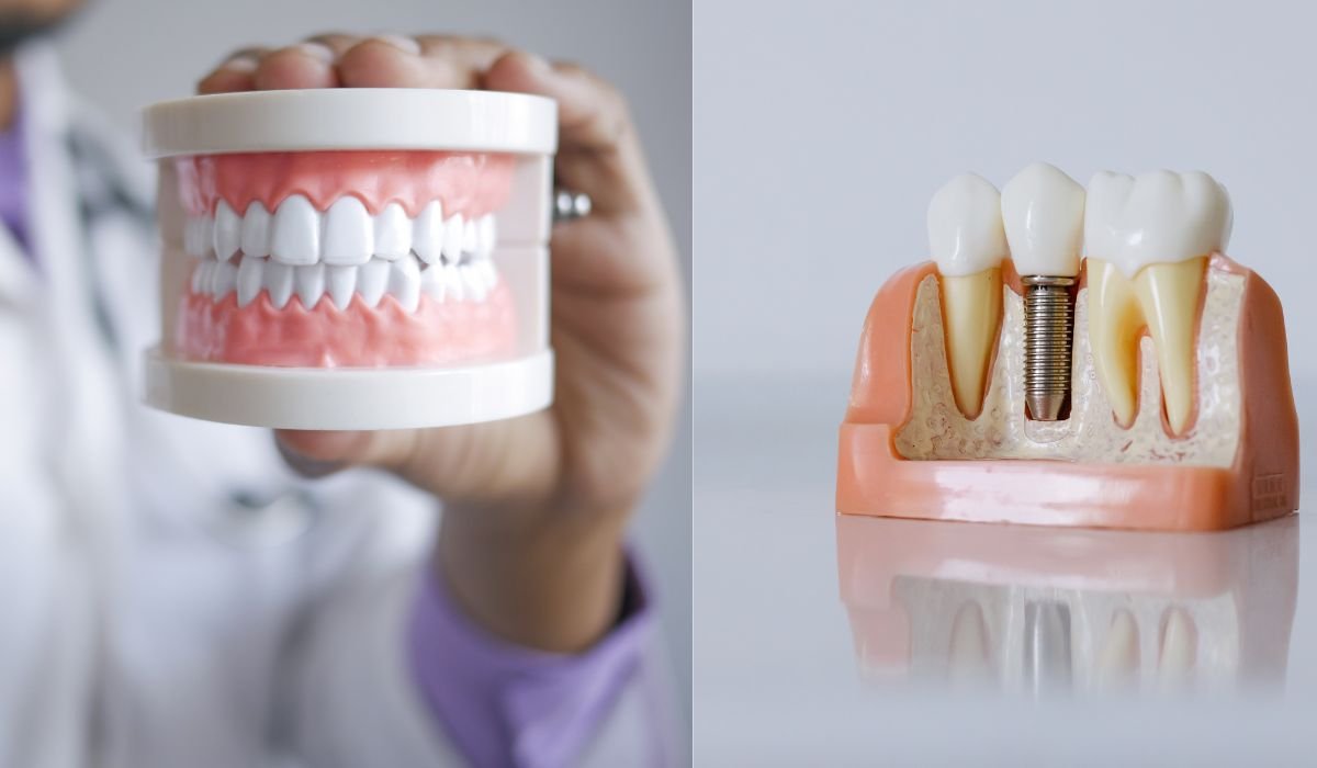 Dentures vs Dental Implants
