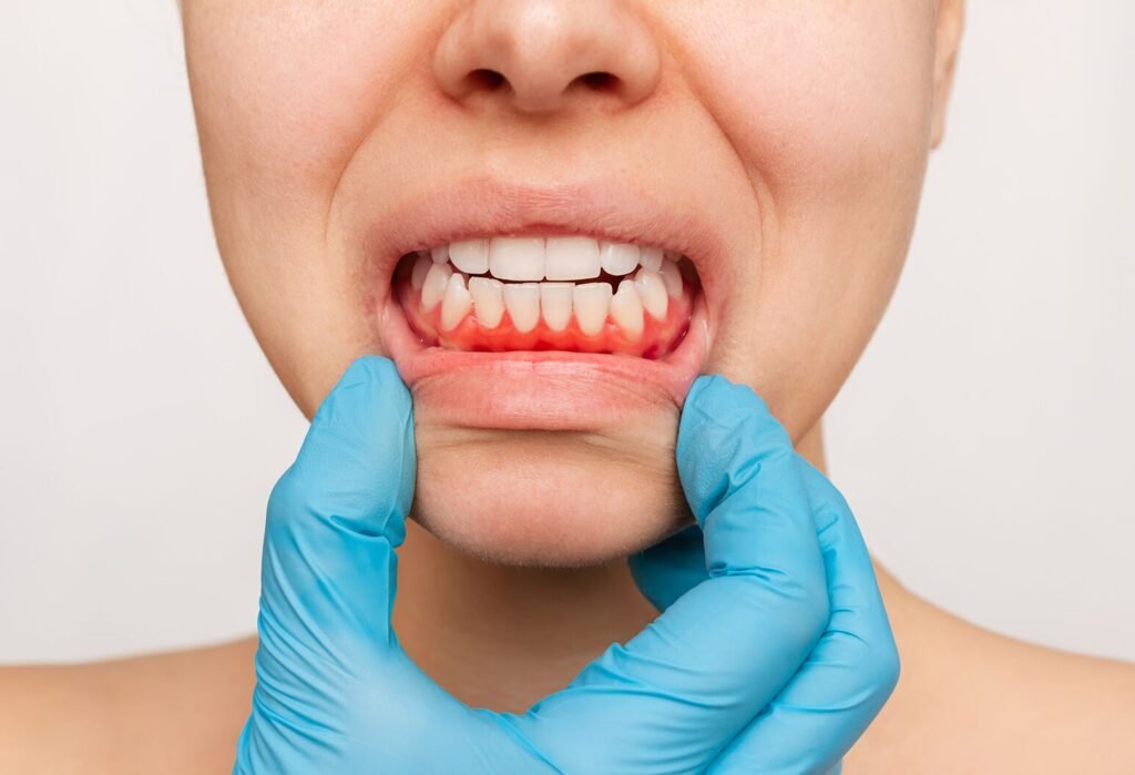 Pregnancy Gum Disease