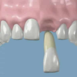 knocked-out tooth