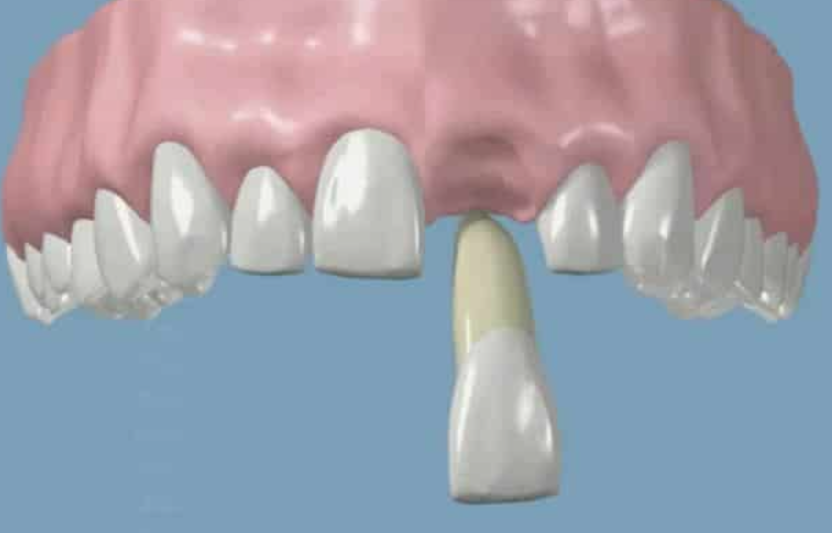 knocked-out tooth